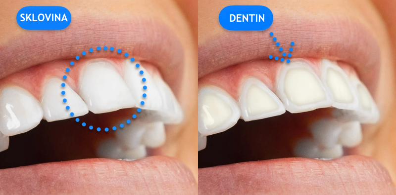 SKLOVINA VS DENTIN